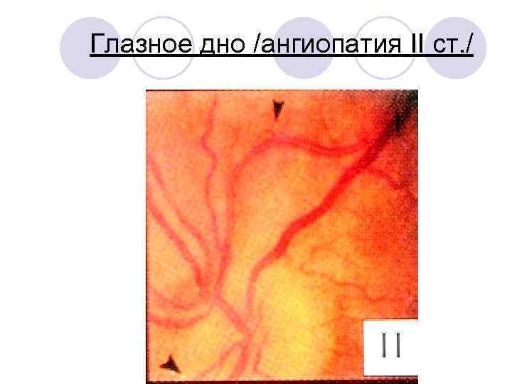 Глазное дно /ангиопатия II ст. / 