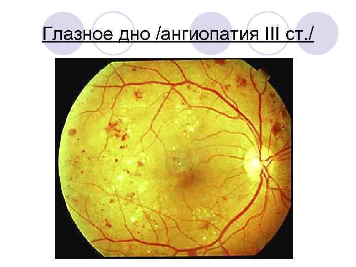 Глазное дно /ангиопатия III ст. / 