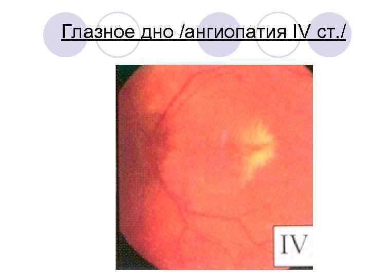 Глазное дно /ангиопатия IV ст. / 