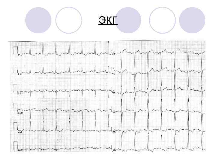 ЭКГ 