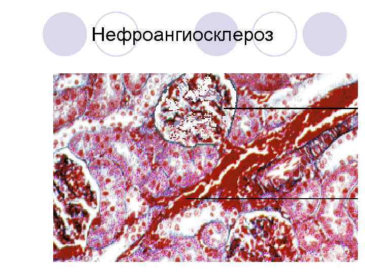 Нефроангиосклероз 