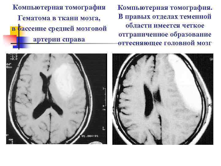 Компьютерная томография Гематома в ткани мозга, в бассеине средней мозговой артерии справа Компьютерная томография.