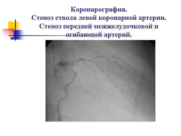 Коронарография. Стеноз ствола левой коронарной артерии. Стеноз передней межжелудочковой и огибающей артерий. 