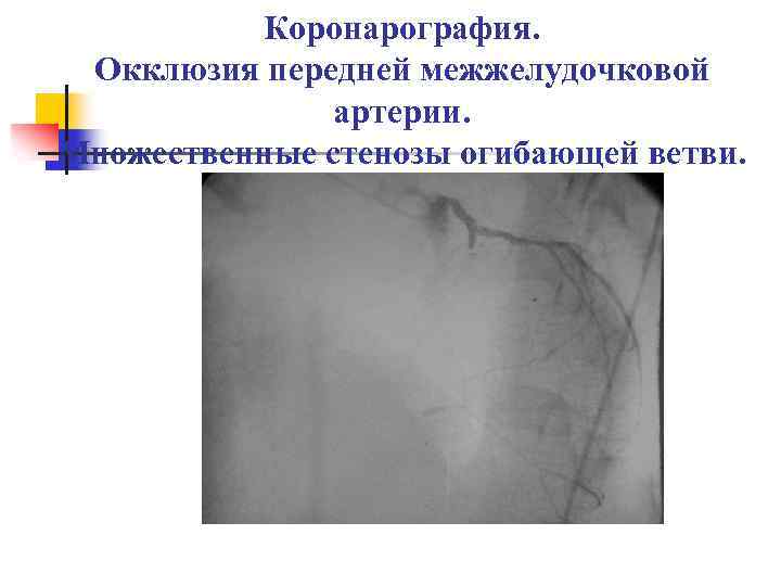 Коронарография. Окклюзия передней межжелудочковой артерии. Множественные стенозы огибающей ветви. 