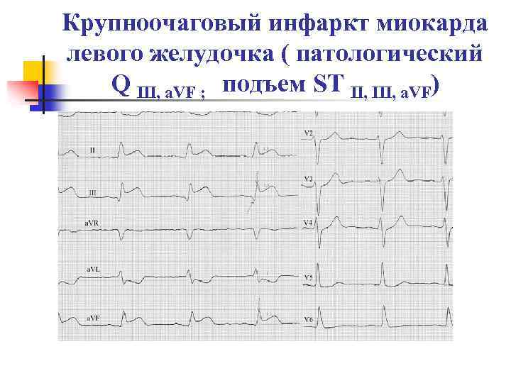 Крупноочаговый инфаркт миокарда левого желудочка ( патологический Q III, a. VF ; подъем ST