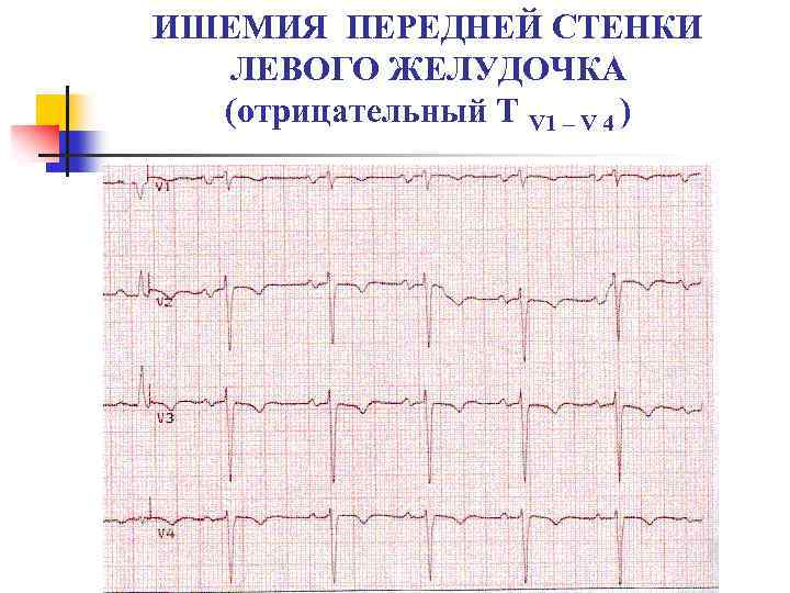 ИШЕМИЯ ПЕРЕДНЕЙ СТЕНКИ ЛЕВОГО ЖЕЛУДОЧКА (отрицательный Т V 1 – V 4 ) 