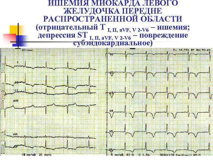 ИШЕМИЯ МИОКАРДА ЛЕВОГО ЖЕЛУДОЧКА ПЕРЕДНЕ РАСПРОСТРАНЕННОЙ ОБЛАСТИ (отрицательный T I, II, a. VF, V