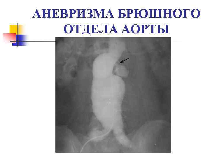 АНЕВРИЗМА БРЮШНОГО ОТДЕЛА АОРТЫ 