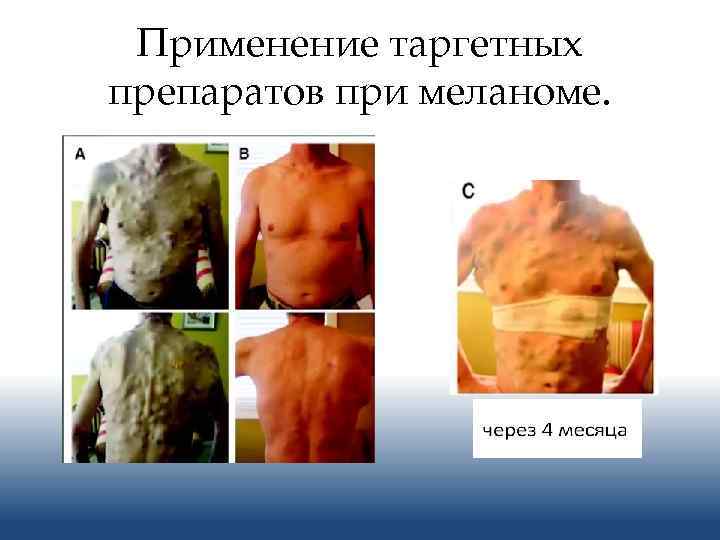 Применение таргетных препаратов при меланоме. 