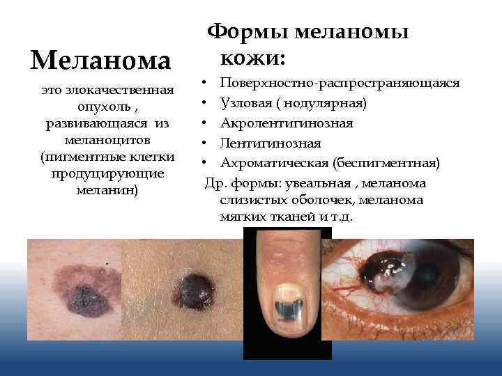 Меланома это злокачественная опухоль , развивающаяся из меланоцитов (пигментные клетки продуцирующие меланин) Формы меланомы