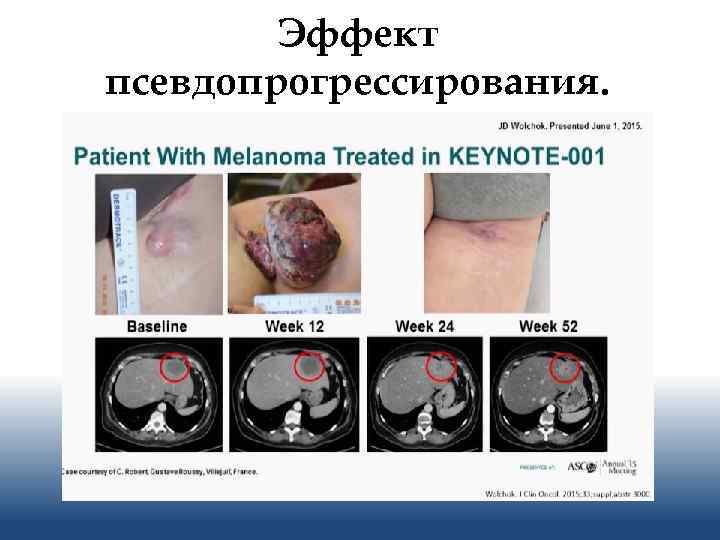 Эффект псевдопрогрессирования. 