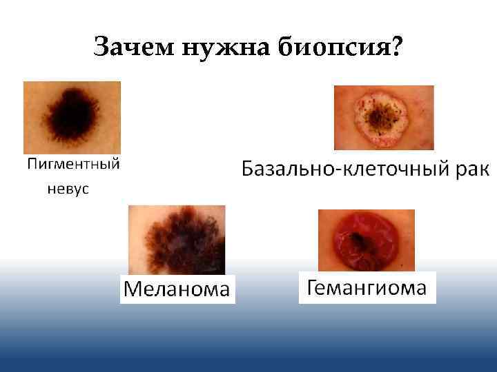 Зачем нужна биопсия? 