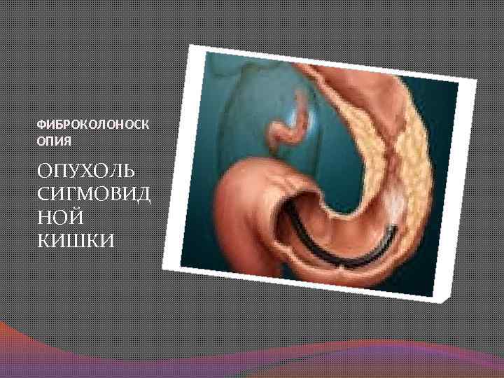 ФИБРОКОЛОНОСК ОПИЯ ОПУХОЛЬ СИГМОВИД НОЙ КИШКИ 