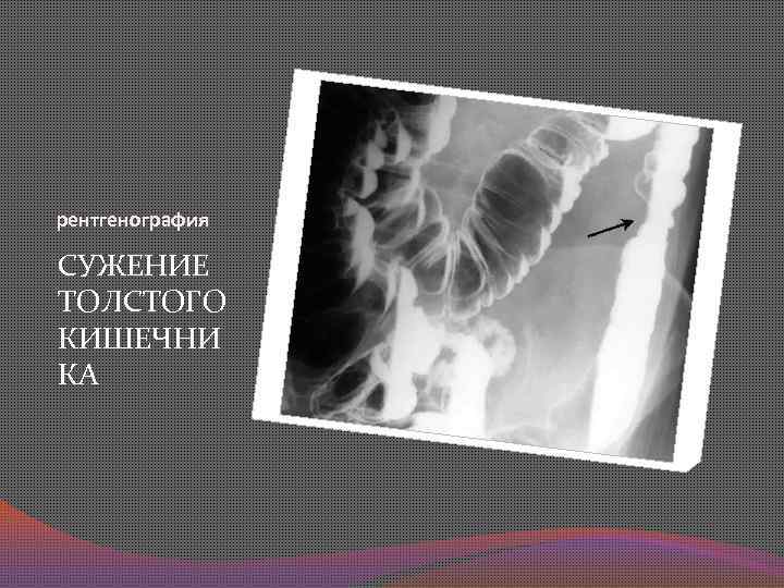 рентгенография СУЖЕНИЕ ТОЛСТОГО КИШЕЧНИ КА 