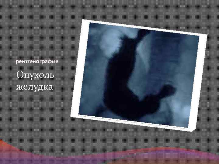 рентгенография Опухоль желудка 