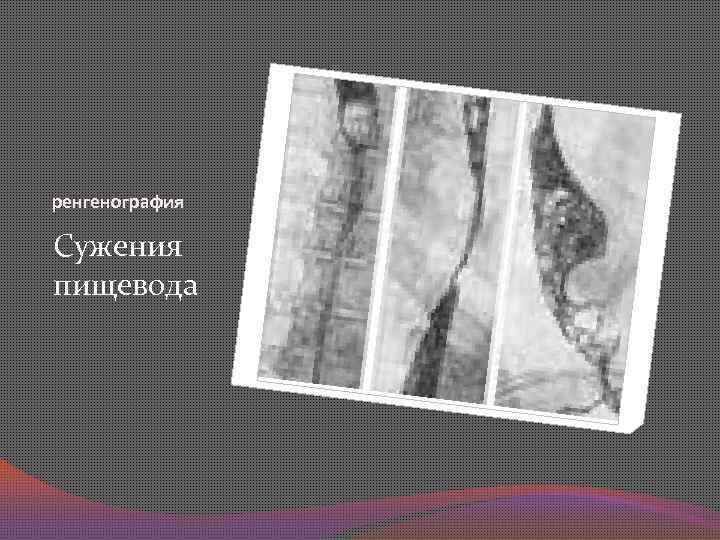 ренгенография Сужения пищевода 