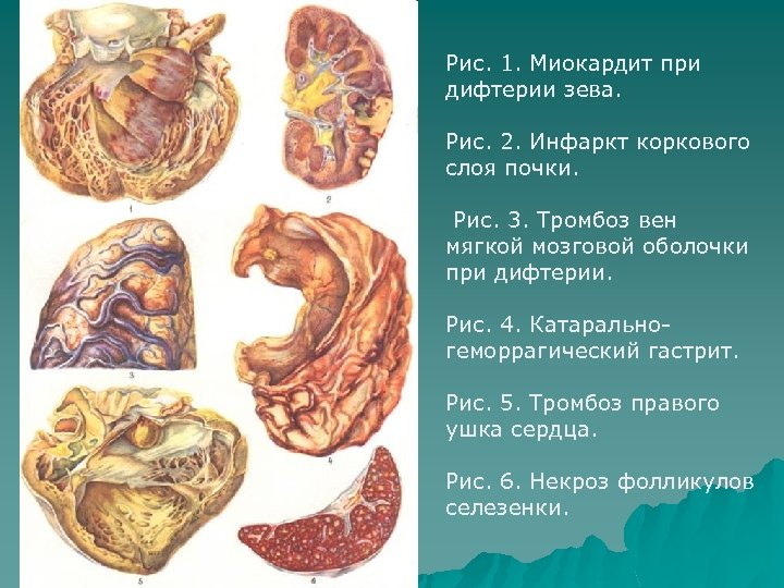 Рис. 1. Миокардит при дифтерии зева. Рис. 2. Инфаркт коркового слоя почки. Рис. 3.