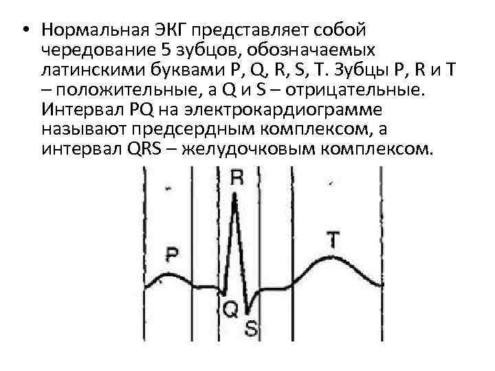  • Нормальная ЭКГ представляет собой чередование 5 зубцов, обозначаемых латинскими буквами P, Q,