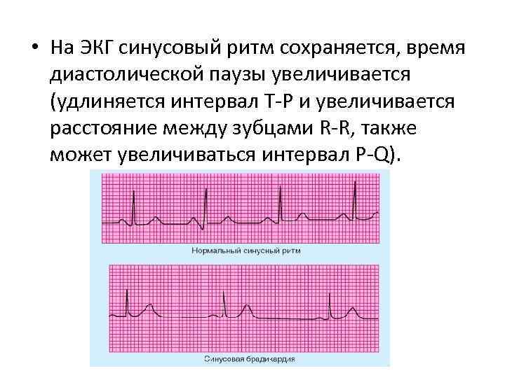  • На ЭКГ синусовый ритм сохраняется, время диастолической паузы увеличивается (удлиняется интервал Т-Р