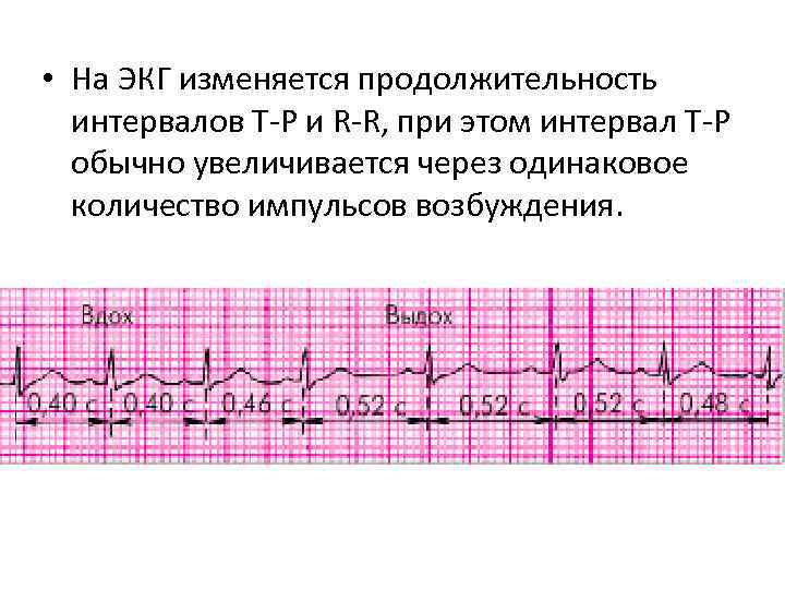  • На ЭКГ изменяется продолжительность интервалов Т-Р и R-R, при этом интервал Т-Р