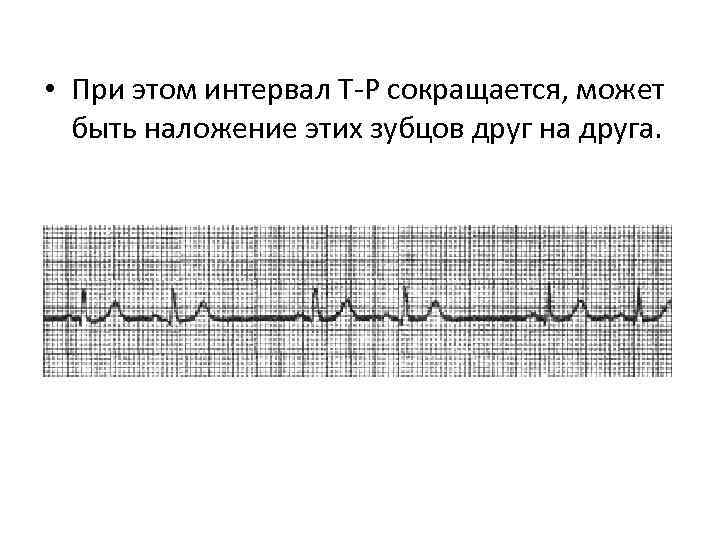  • При этом интервал Т-Р сокращается, может быть наложение этих зубцов друг на