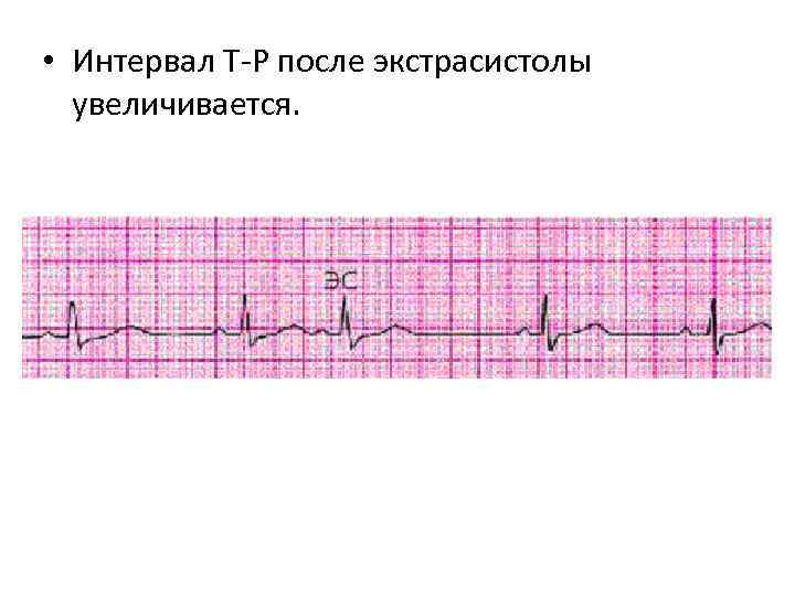  • Интервал Т-Р после экстрасистолы увеличивается. 