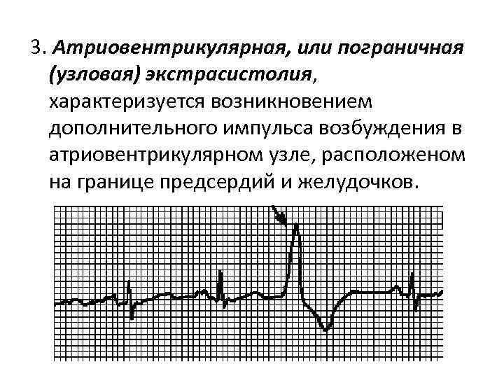 3. Атриовентрикулярная, или пограничная (узловая) экстрасистолия, характеризуется возникновением дополнительного импульса возбуждения в атриовентрикулярном узле,