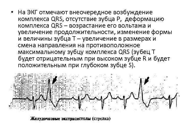  • На ЭКГ отмечают внеочередное возбуждение комплекса QRS, отсутствие зубца Р, деформацию комплекса