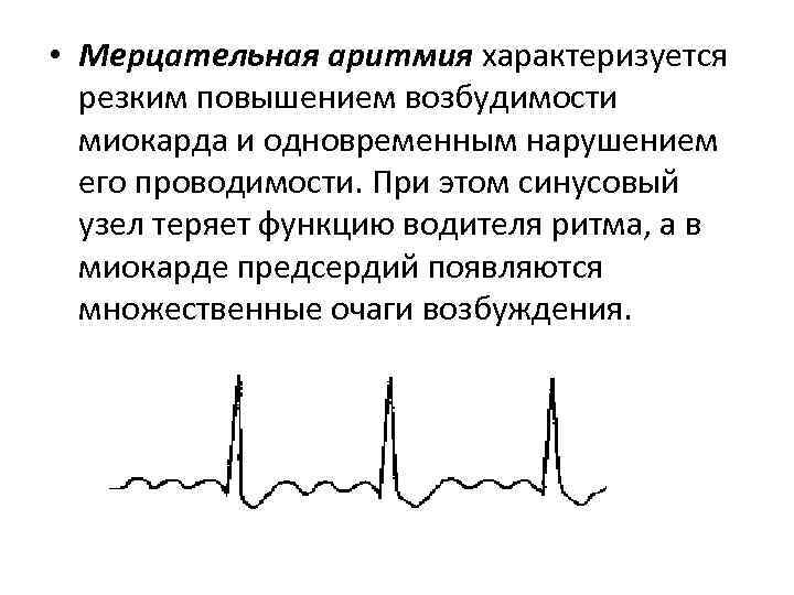  • Мерцательная аритмия характеризуется резким повышением возбудимости миокарда и одновременным нарушением его проводимости.