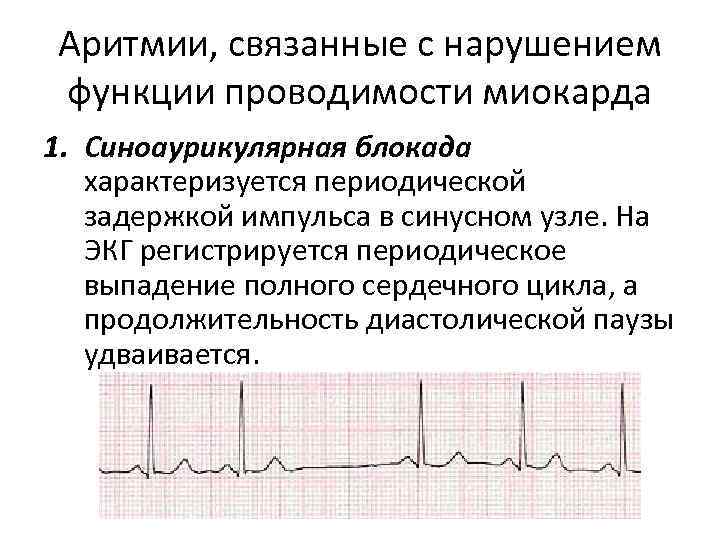 Аритмии, связанные с нарушением функции проводимости миокарда 1. Синоаурикулярная блокада характеризуется периодической задержкой импульса