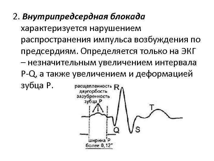 2. Внутрипредсердная блокада характеризуется нарушением распространения импульса возбуждения по предсердиям. Определяется только на ЭКГ