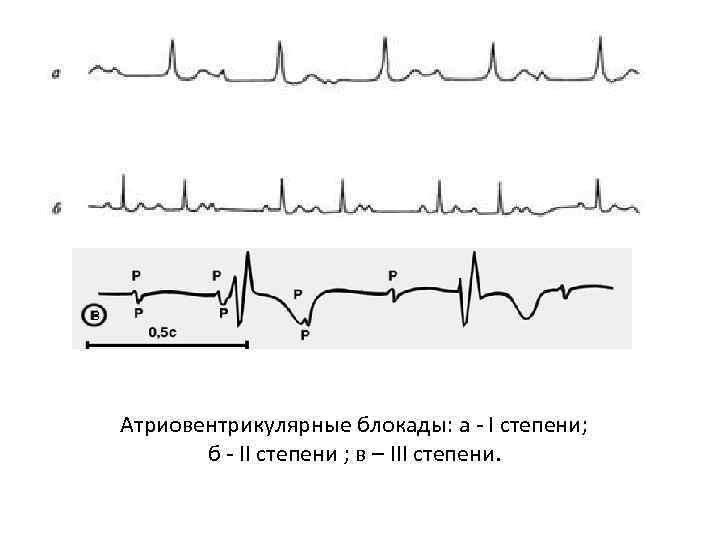 Атриовентрикулярные блокады: а - I степени; б - II степени ; в – III