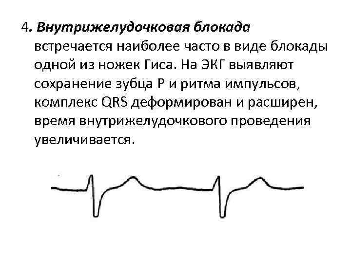 4. Внутрижелудочковая блокада встречается наиболее часто в виде блокады одной из ножек Гиса. На