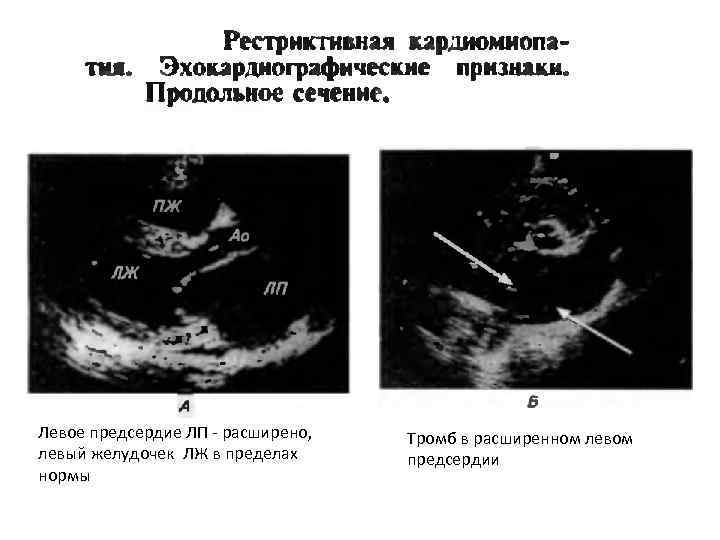 Левое предсердие ЛП - расширено, левый желудочек ЛЖ в пределах нормы Тромб в расширенном