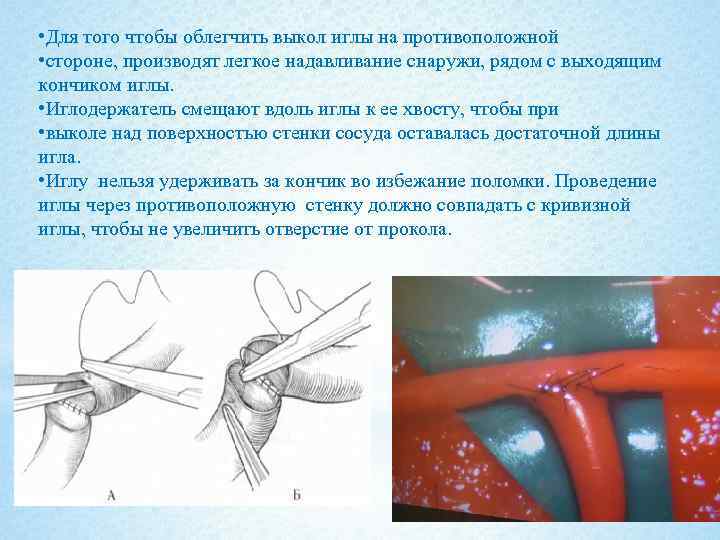  • Для того чтобы облегчить выкол иглы на противоположной • стороне, производят легкое