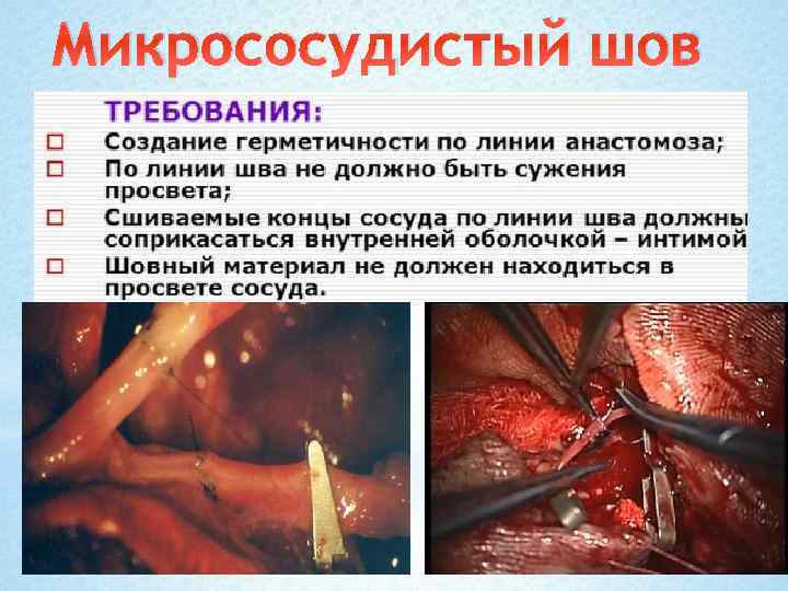 Микрососудистый шов 