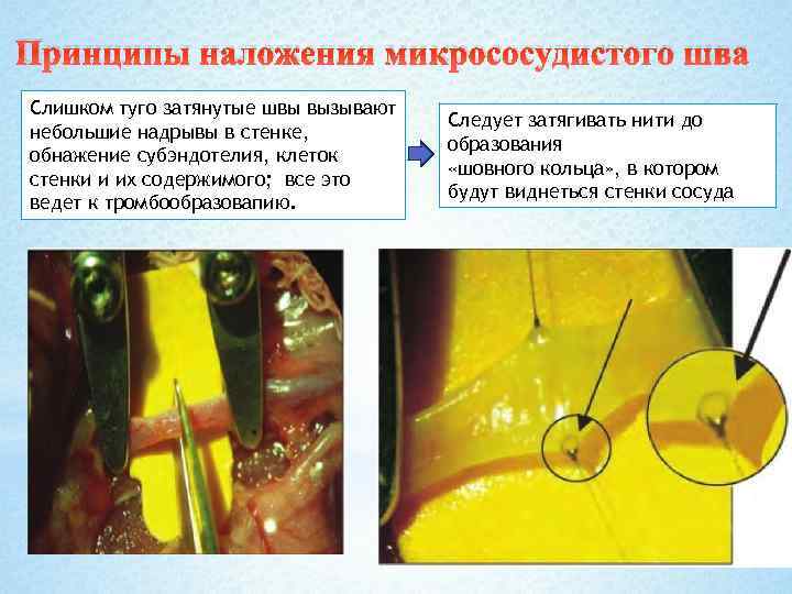 Принципы наложения микрососудистого шва Слишком туго затянутые швы вызывают небольшие надрывы в стенке, обнажение
