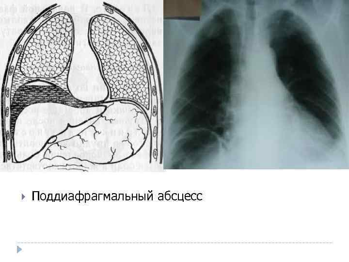  Поддиафрагмальный абсцесс 