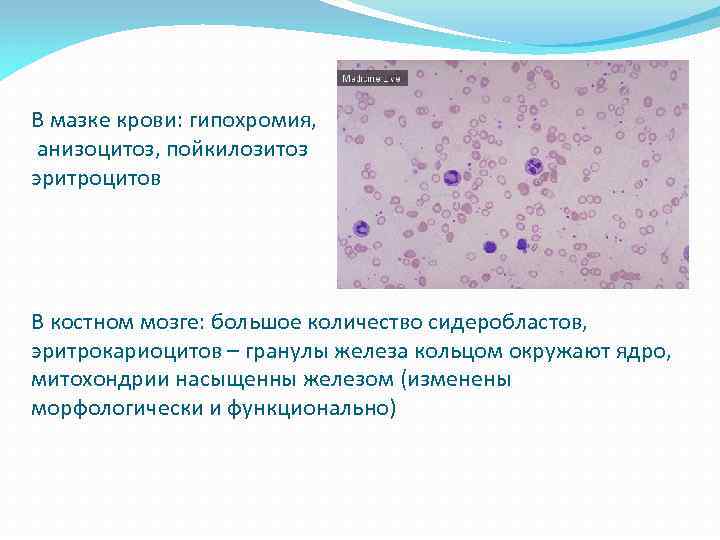 В мазке крови: гипохромия, анизоцитоз, пойкилозитоз эритроцитов В костном мозге: большое количество сидеробластов, эритрокариоцитов