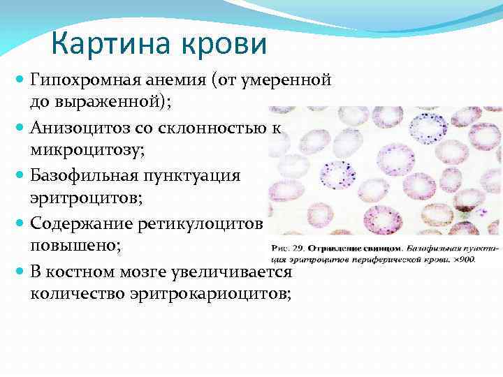 Картина крови Гипохромная анемия (от умеренной до выраженной); Анизоцитоз со склонностью к микроцитозу; Базофильная