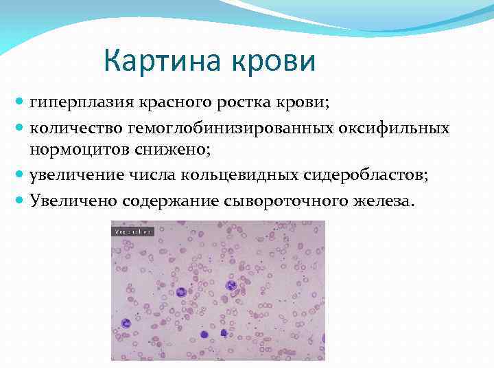 Картина крови гиперплазия красного ростка крови; количество гемоглобинизированных оксифильных нормоцитов снижено; увеличение числа кольцевидных