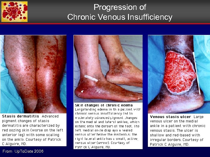 Progression of Chronic Venous Insufficiency From Up. To. Date 2006 