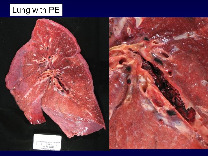 Lung with PE 