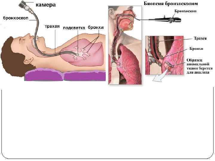 Биопсия через желудок. Бронхоскоп строение. Жесткий бронхоскоп. Ригидный бронхоскоп. Бронхоскоп Фриделя.