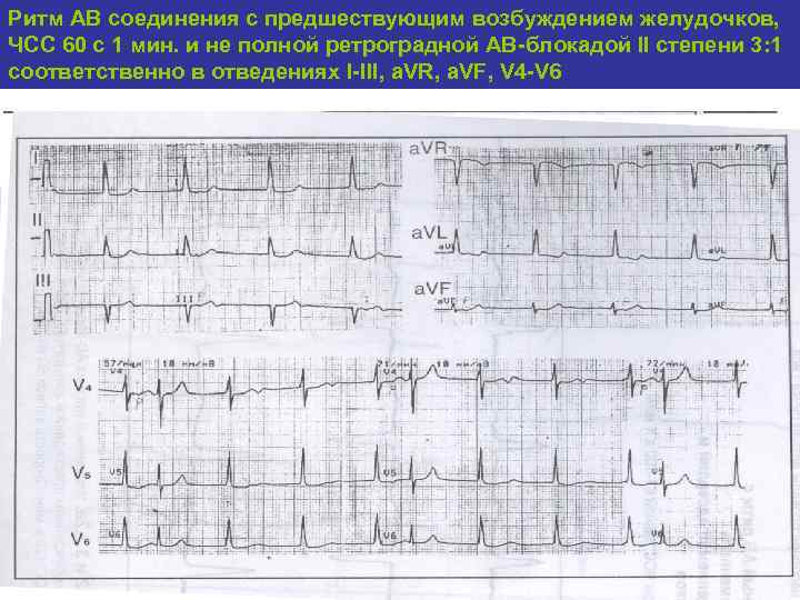 Ритм АВ соединения с предшествующим возбуждением желудочков, ЧСС 60 с 1 мин. и не