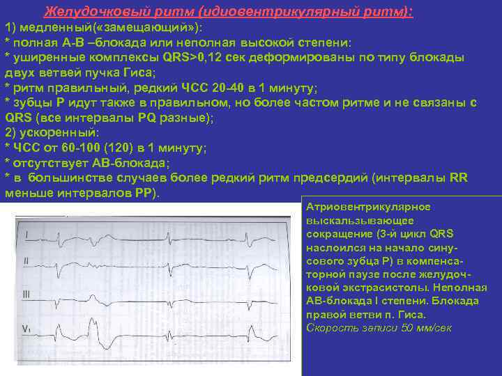 Желудочковый ритм (идиовентрикулярный ритм): 1) медленный( «замещающий» ): * полная А-В –блокада или неполная