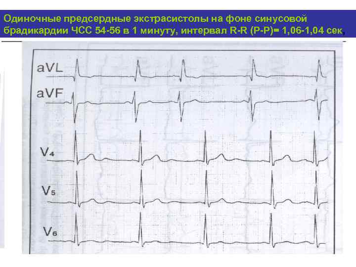 Частые желудочковые экстрасистолы карта вызова