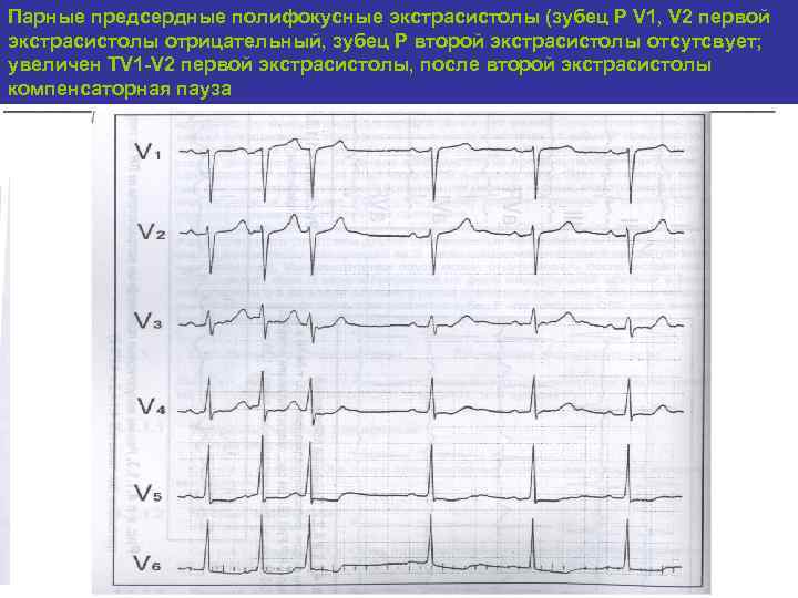 Парные предсердные полифокусные экстрасистолы (зубец Р V 1, V 2 первой экстрасистолы отрицательный, зубец