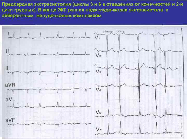 Предсердная экстрасистолия (циклы 3 и 6 в отведениях от конечностей и 2 -й цикл
