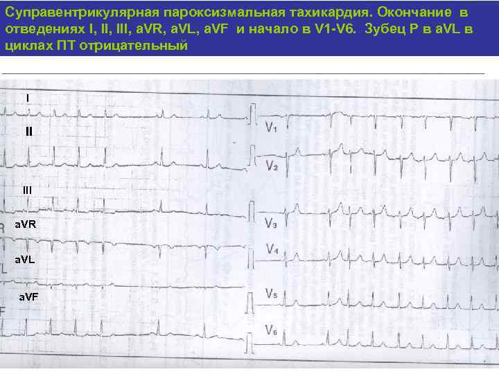 Суправентрикулярная пароксизмальная тахикардия. Окончание в отведениях I, III, a. VR, a. VL, a. VF